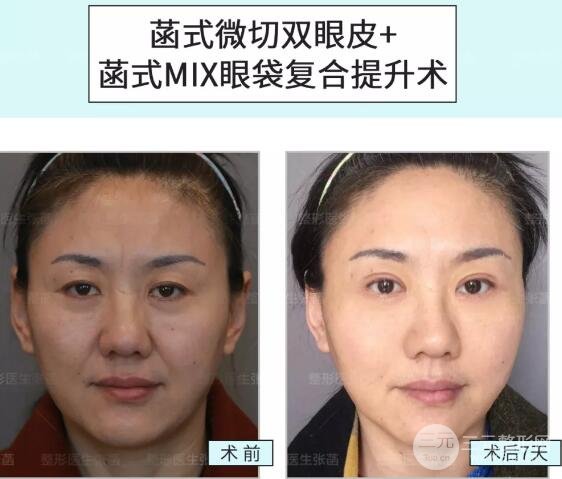 做眼袋术后注意事项
