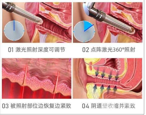 阴道缩紧手术方式