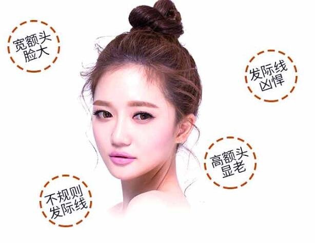 种植头发价钱是多少?怎么计算?