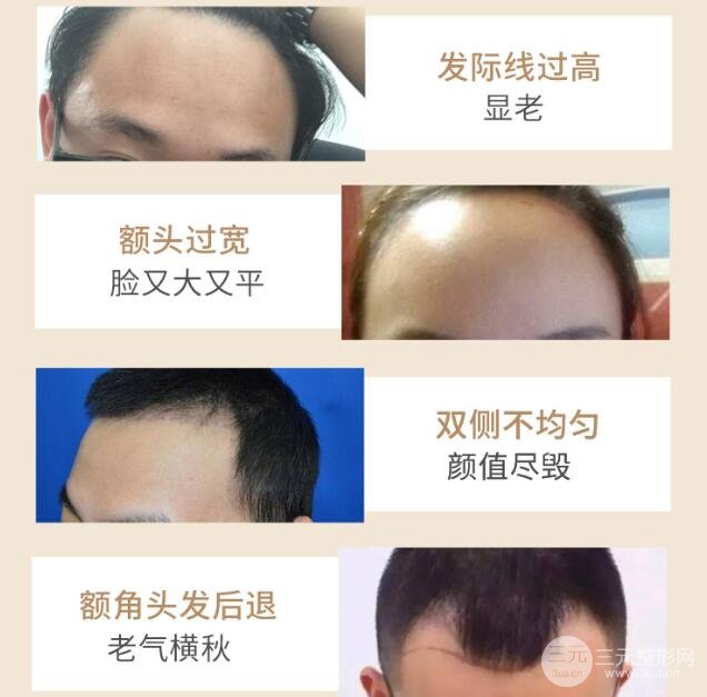 种植头发价钱: