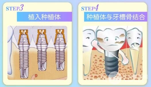 2020湘雅医院种植牙技术