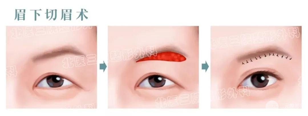 切眉术适合多大年龄做