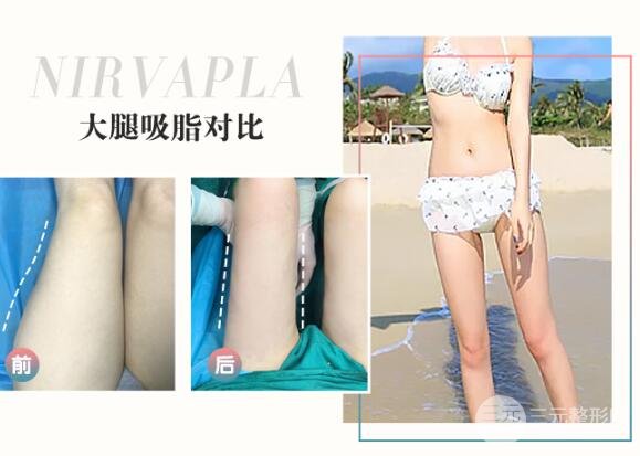 抽脂瘦腿优势