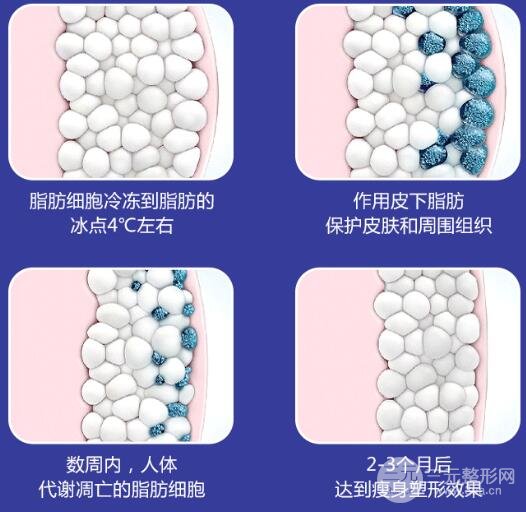 酷塑冷冻溶脂做需要几次?