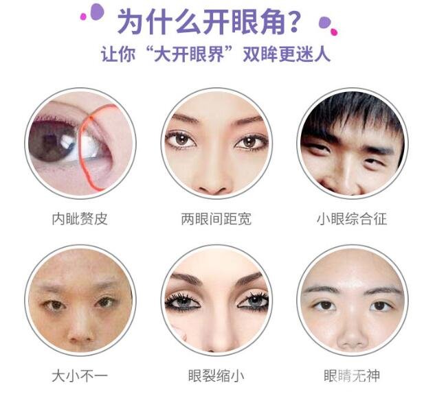 开眼角恢复时间?