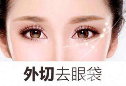 外切去眼袋多久恢复自然？看完你就懂了~