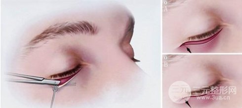 外切去眼袋多久恢复自然？看完你就懂了~