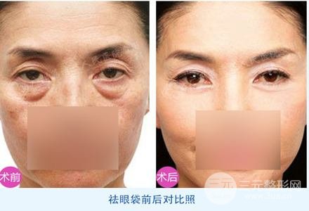 外切去眼袋多久恢复自然？看完你就懂了~