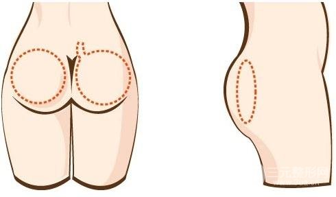 但是选择正规专业的医生可以降低手术风险,提臀术一般大致有如下几个