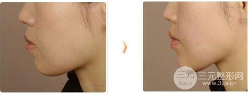 下巴打玻尿酸大概需要多少量？不多，只需要这点！