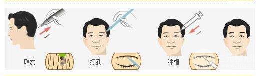 植眉价格贵吗？美眉们的美丽攻略来咯！