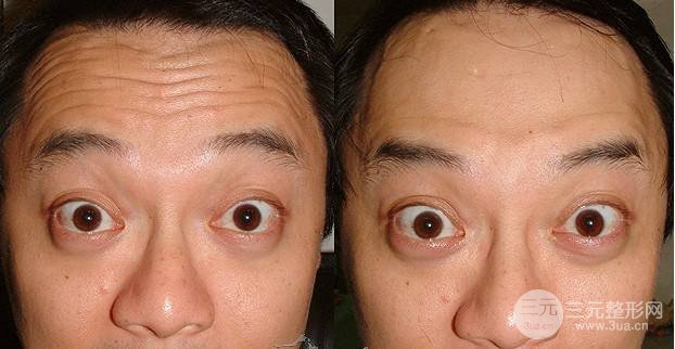 拉皮手术多少钱？做一次管好几年，值了！