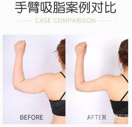 手臂抽脂多久恢复消肿?别着急,先做好这些事!