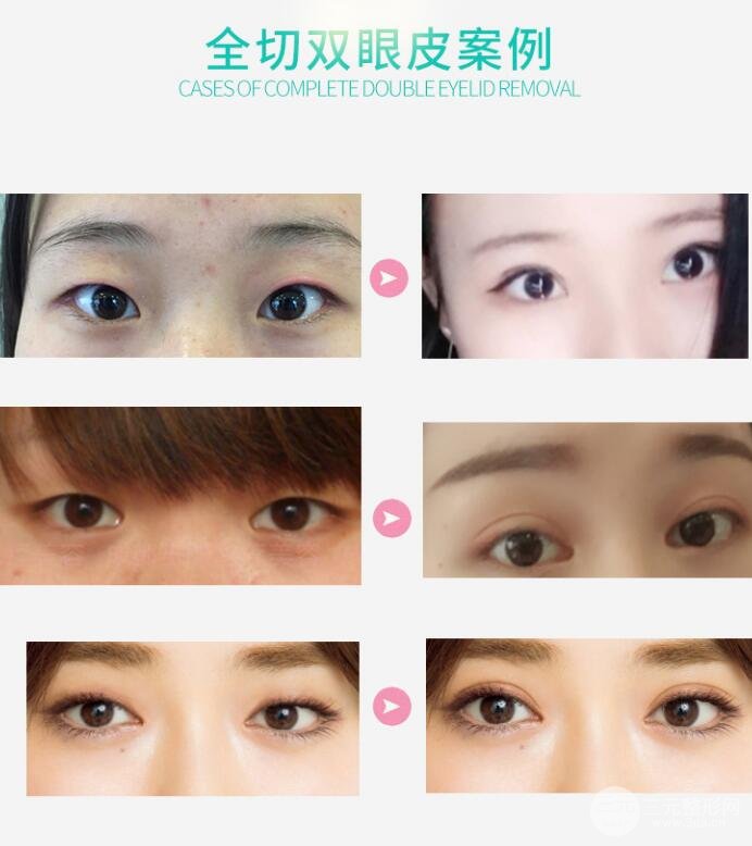 开双眼皮多少钱?白菜价get美眼
