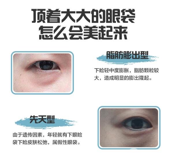修复眼袋手术方式