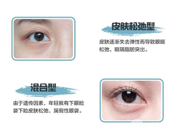 修复眼袋手术方式