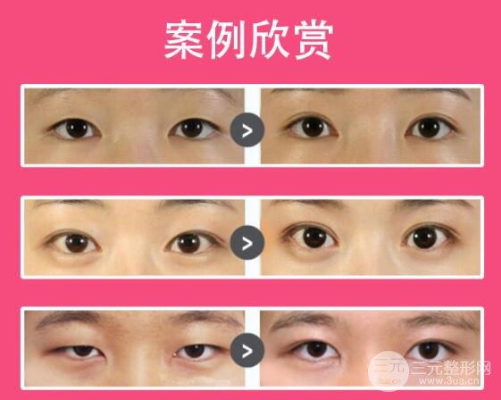 开外眼角果