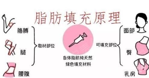 脂肪填充全脸一个月可以恢复自然吗~