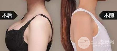 隆胸前后照片：想要果自然还是选择自体脂肪吧！