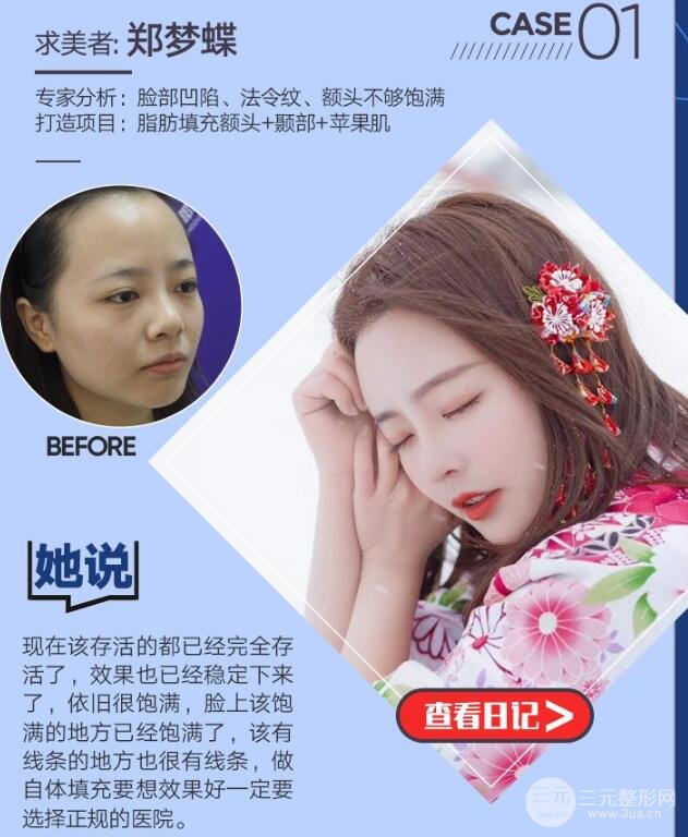自体脂肪填充太阳穴案例