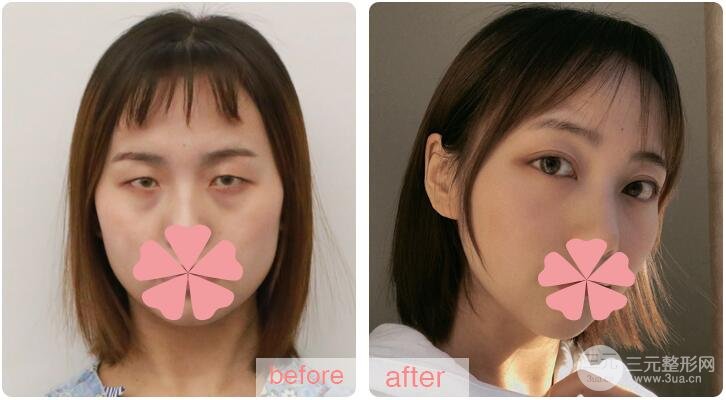 激光去眼袋多少钱？贵吗？别让你的眼袋越变越大！