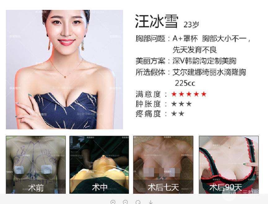 扒一扒娜绮丽假体型号及图片