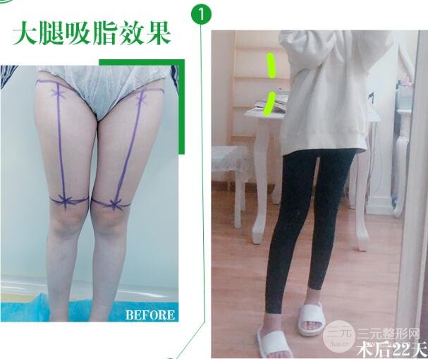 大腿吸脂果