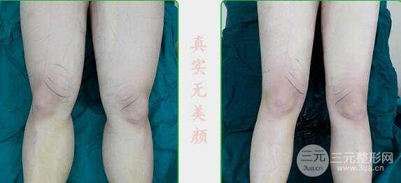 大腿吸脂护理