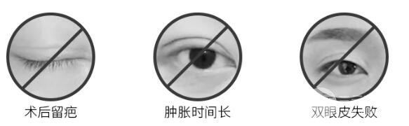 全切双眼皮价格