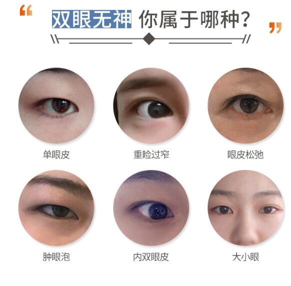 想割双眼皮,这3种方式先来了解一下