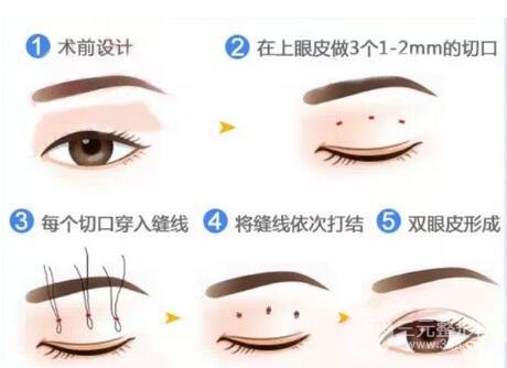 双眼皮买埋线法