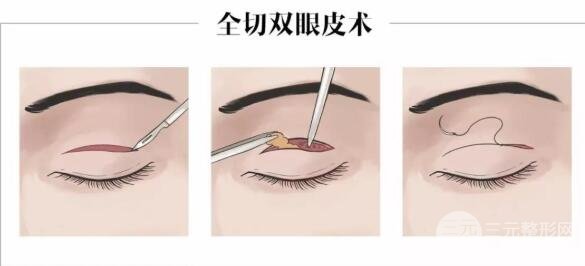 双眼皮全切法