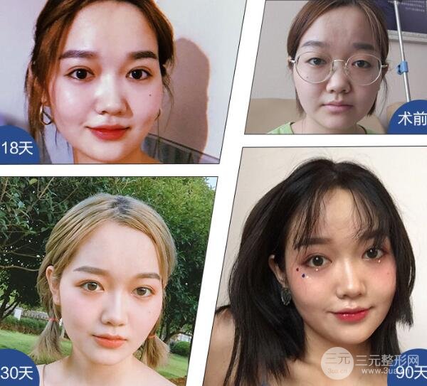 双眼皮微创三点法