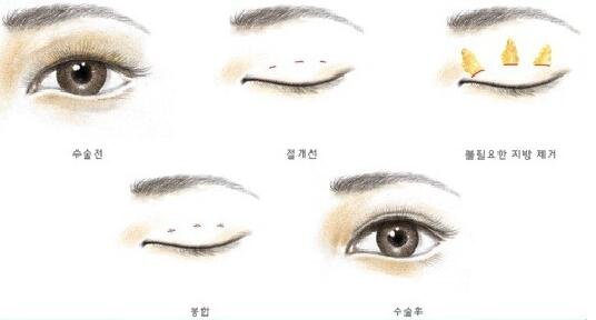 双眼皮微创三点法