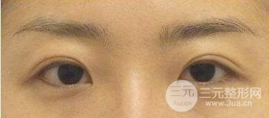 眼袋怎么消除?