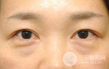 眼袋怎么消除?