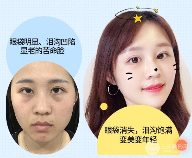 眼袋手术以后注意事项