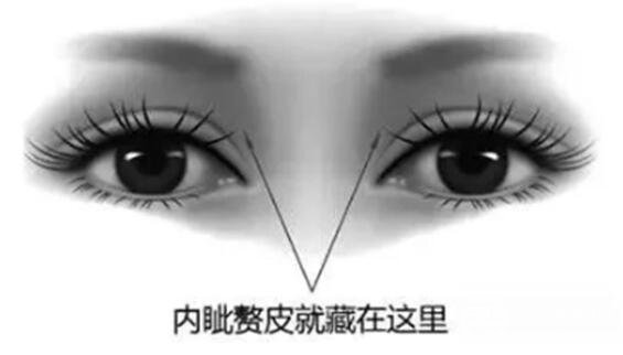 内眦赘皮和开眼角手术