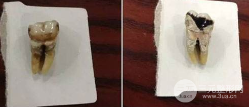 抽烟种植牙失败