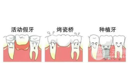 种植牙这些人要谨慎