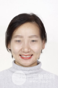 正畸后咬肌消失