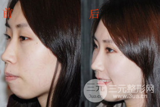 整牙真的会改变脸型吗