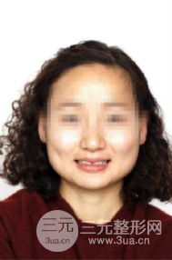 正畸后咬肌消失