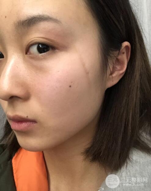 上海九院董继英怎么样激光祛疤真实果你见过吗