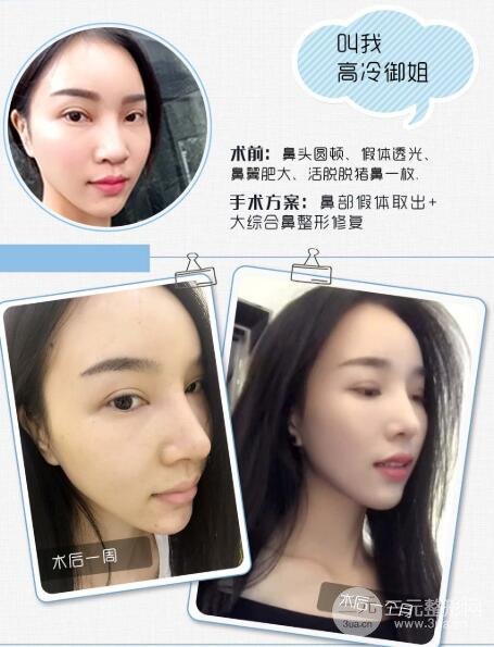 修复鼻子前需要注意的事项