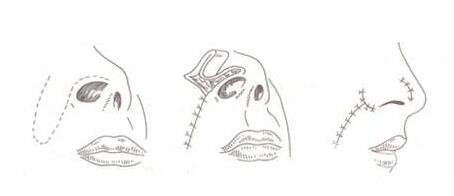 鼻翼缺损修复手术的步骤