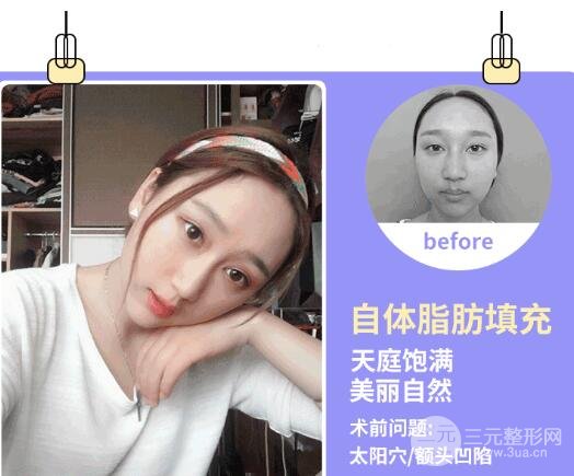 玻尿酸填充手术