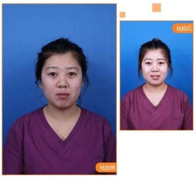 祛痘前的注意事项