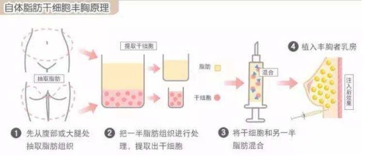 自体脂肪隆胸手术失败修复方法 价格是多少呢？