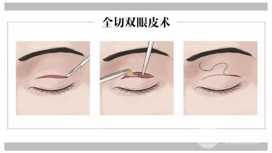 一般做双眼皮多少钱?贫民窟女孩能hold住吗?